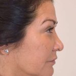 Liposuction Before & After Patient #438