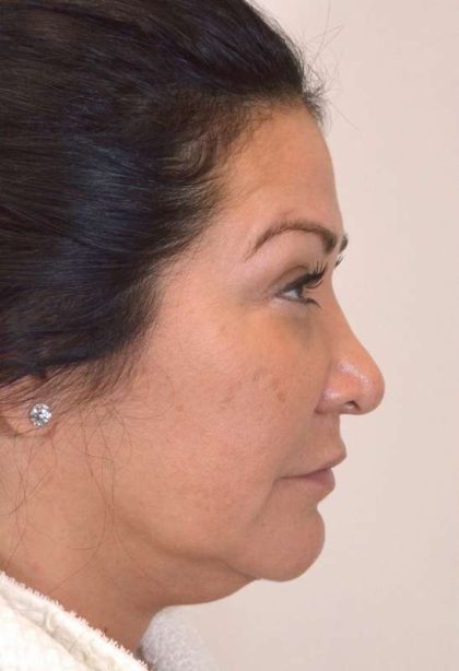 Liposuction Before & After Patient #438