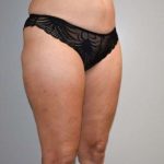 Liposuction Before & After Patient #448