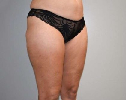 Liposuction Before & After Patient #448