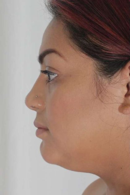 Liposuction Before & After Patient #458