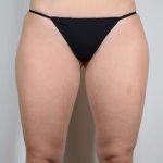 Liposuction Before & After Patient #468