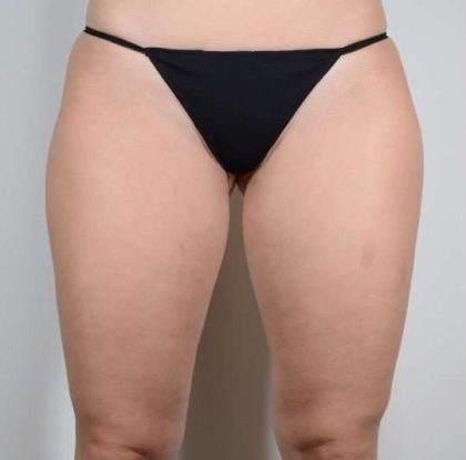 Liposuction Before & After Patient #468