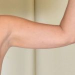 Liposuction Before & After Patient #473