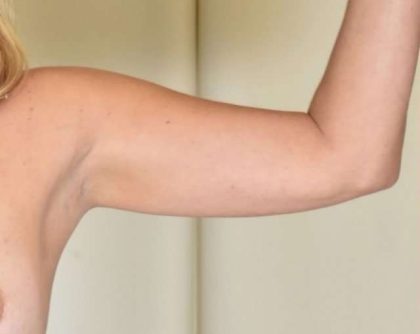 Liposuction Before & After Patient #473