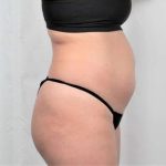Liposuction Before & After Patient #480