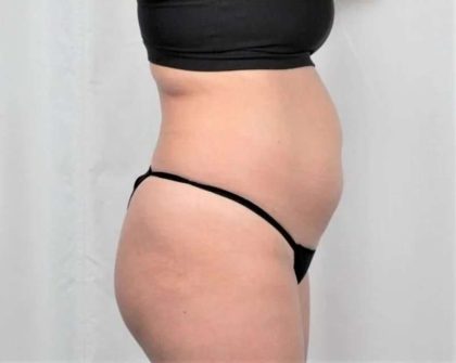 Liposuction Before & After Patient #480
