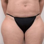 Liposuction Before & After Patient #491
