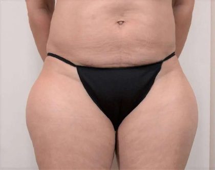 Liposuction Before & After Patient #491