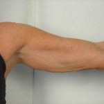 Arm Lift Before & After Patient #496