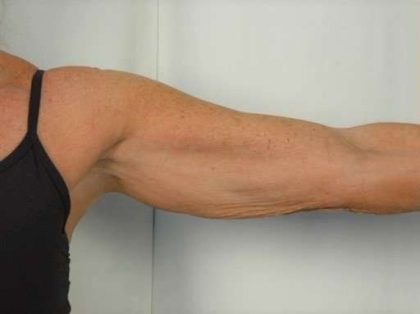 Arm Lift Before & After Patient #496