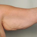 Arm Lift Before & After Patient #501