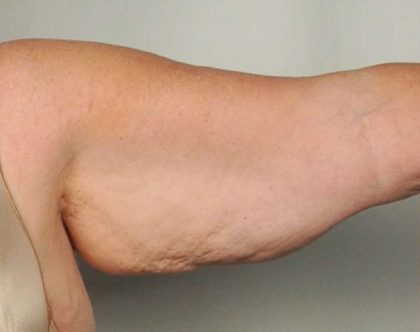 Arm Lift Before & After Patient #501
