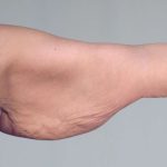 Arm Lift Before & After Patient #506