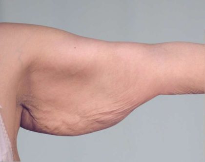 Arm Lift Before & After Patient #506