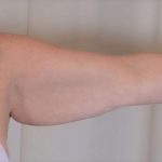 Arm Lift Before & After Patient #511