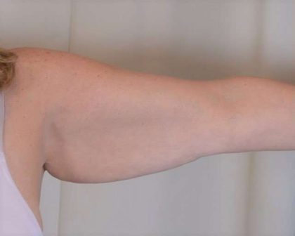 Arm Lift Before & After Patient #511