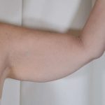 Arm Lift Before & After Patient #516