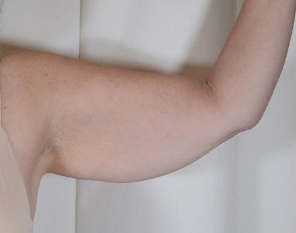 Arm Lift Before & After Patient #516