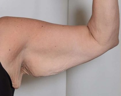 Arm Lift Before & After Patient #521