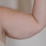 Arm Lift Before & After Patient #526