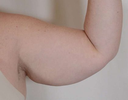 Arm Lift Before & After Patient #526