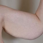 Arm Lift Before & After Patient #531