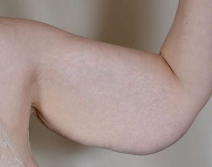 Arm Lift Before & After Patient #531