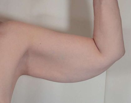 Arm Lift Before & After Patient #536