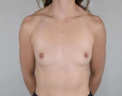 Breast Augmentation Before & After Patient #566