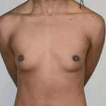 Breast Augmentation Before & After Patient #571