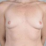 Breast Augmentation Before & After Patient #596