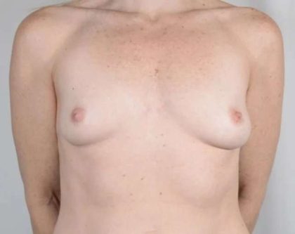 Breast Augmentation Before & After Patient #596