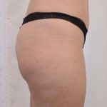 Brazilian Butt Lift Before & After Patient #413