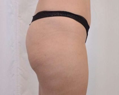 Brazilian Butt Lift Before & After Patient #413