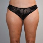 Liposuction Before & After Patient #448