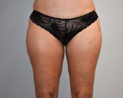 Liposuction Before & After Patient #448