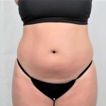 Liposuction Before & After Patient #480