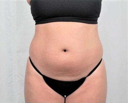 Liposuction Before & After Patient #480
