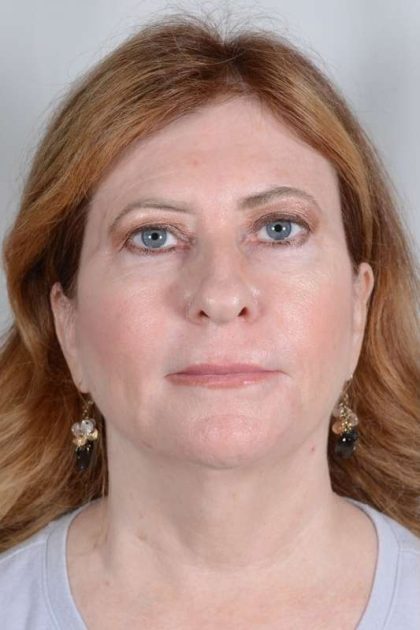 Neck Lift Before & After Patient #1075