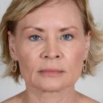Facial Fat Transfer & Grafting Before & After Patient #1215