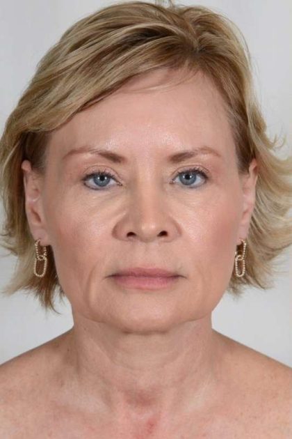 Facial Fat Transfer & Grafting Before & After Patient #1215