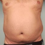 Men's Liposuction Before & After Patient #1396