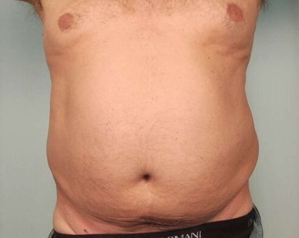 Men's Liposuction Before & After Patient #1396