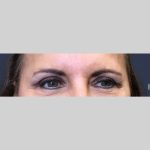 Botox Before & After Patient #3455