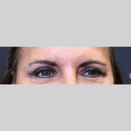 Botox Before & After Patient #3455
