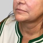 Dermal Filler Before & After Patient #3513