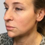 Dermal Filler Before & After Patient #3514