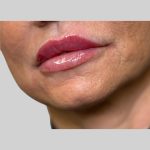 Dermal Filler Before & After Patient #3515