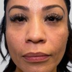Dermal Filler Before & After Patient #3517